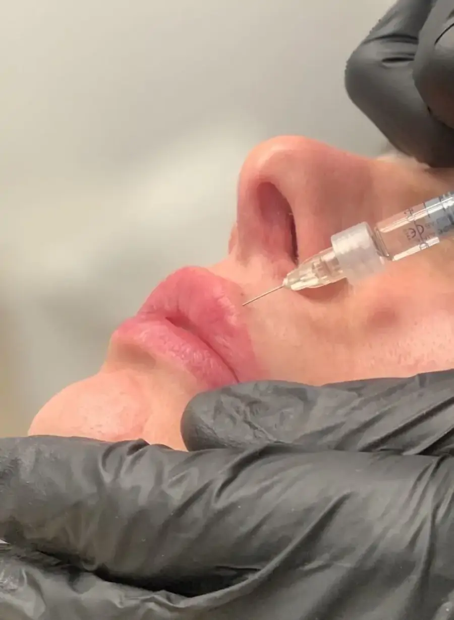 Filler labbra Torino: la guida completa per un risultato naturale