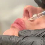 Filler labbra Torino: la guida completa per un risultato naturale