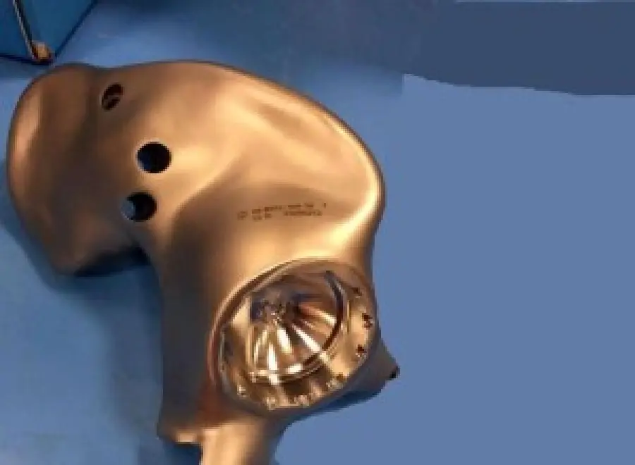 Torino, primo trapianto mondiale di bacino